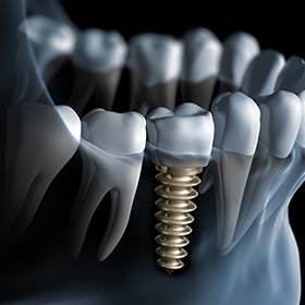 illustration of screwed in implant