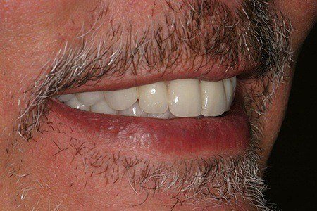 patient 2 after