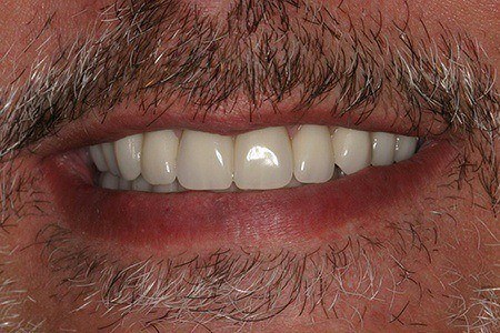 patient 2c after