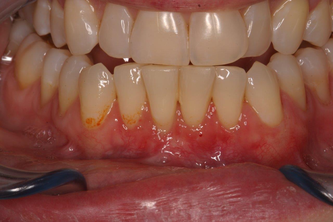 patient 11 after