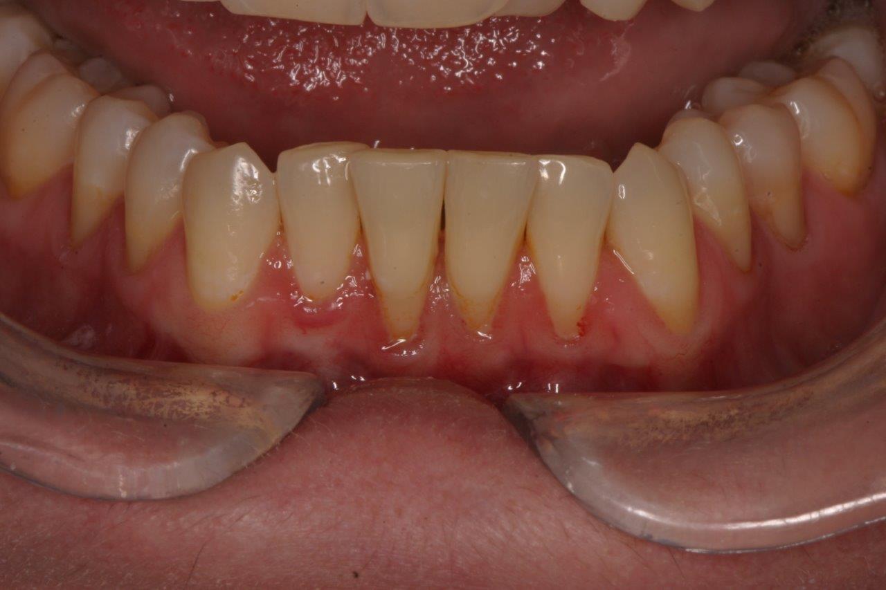 patient 11 before