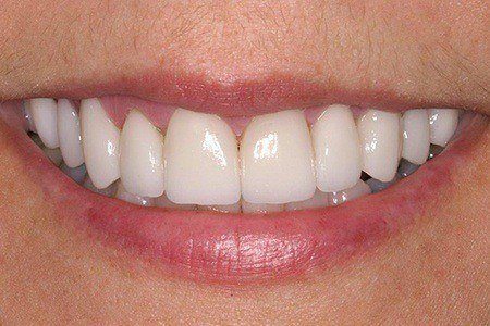 patient 4 after
