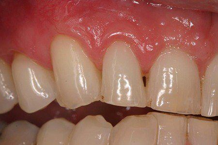 patient 5 after