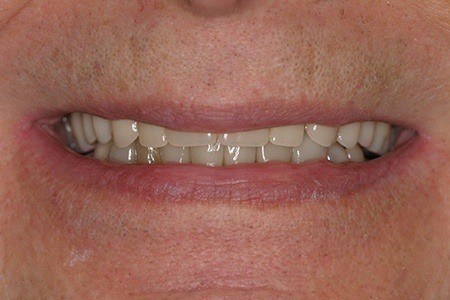 patient 8 after