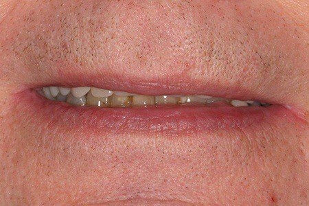patient 8 before