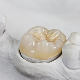 a close-up of a dental crown on a model tooth