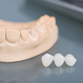 dental bridge example