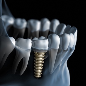 Animation of implant supported dental crown