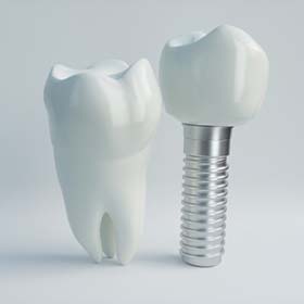 model of a real tooth next to a dental implant in Lawrenceville