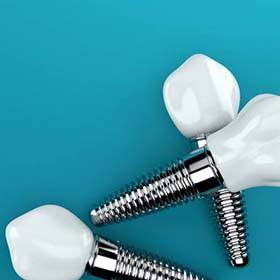 three dental implants in front of a blue background