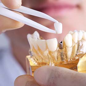 dentist placing a crown on top of a dental implant in a model of the jaw