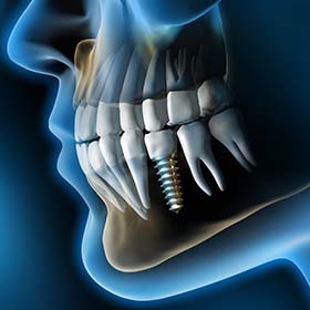 X-ray of a patient with a dental implant