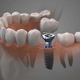 model of a single dental implant with a crown
