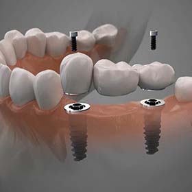 model of two dental implants with a bridge