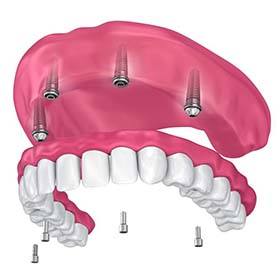 model of four dental implants supporting a full denture