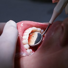 checking bottom teeth