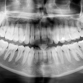 x-ray of full mouth
