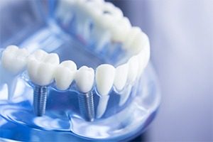 Dental implant model