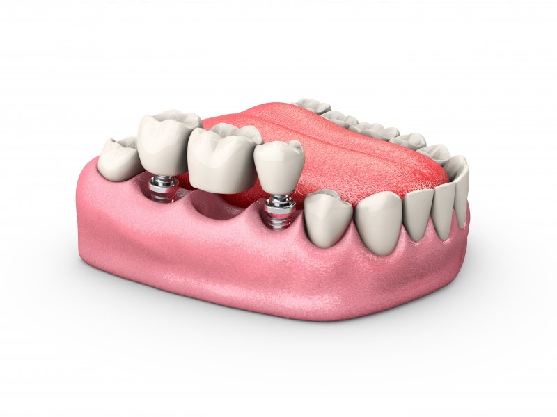 Dental Implant Bridge