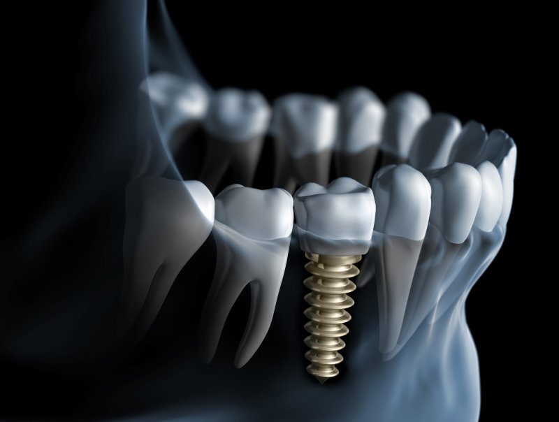 Dental implants in Lawrenceville