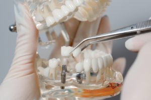 Model of dental implants in Lawrenceville.