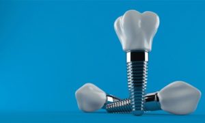 dental implants against a blue background 