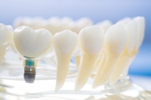 Model of a single dental implant