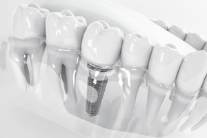 Illustration of dental implant in a plastic tray